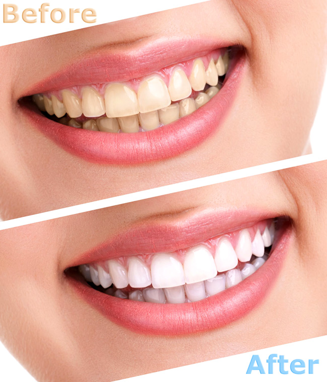 So sánh trước và sau khi tẩy trắng trăng