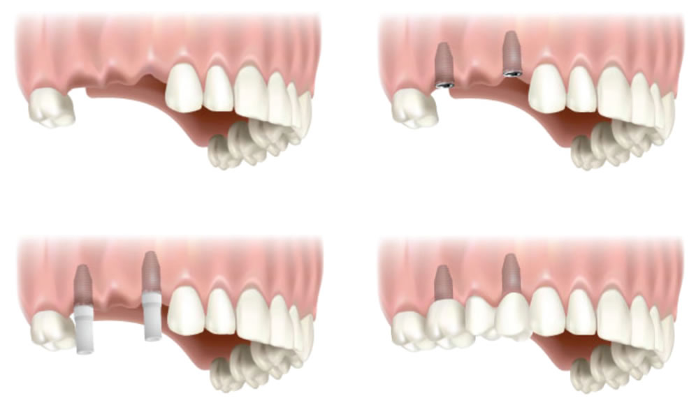 Trồng răng implant