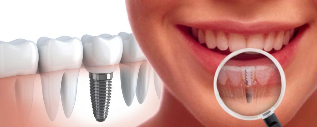 Chăm Sóc Răng Implant Như Thế Nào?