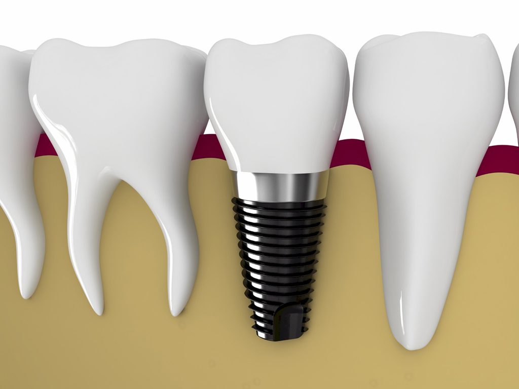 Implant Nha Khoa Tồn Tại Bao Lâu?