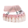 Cắm – Ghép Implant: Giải Pháp Tối Ưu Để Phục Hồi Những Răng Đã Mất