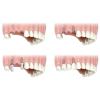 Trồng Răng Implant Ở Đâu Tốt Quận 1