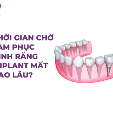 Thời Gian Chờ Làm Phục Hình Răng Implant Mất Bao Lâu?