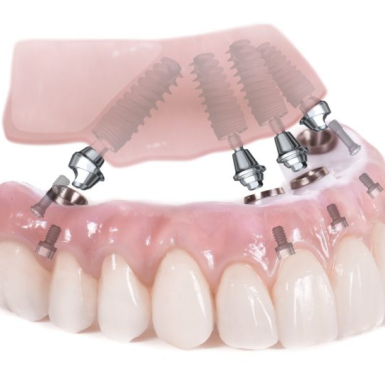 Cắm – Ghép Implant: Giải Pháp Tối Ưu Để Phục Hồi Những Răng Đã Mất