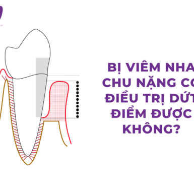 Bị Viêm Nha Chu Nặng Có Điều Trị Dứt Điểm Được Không?