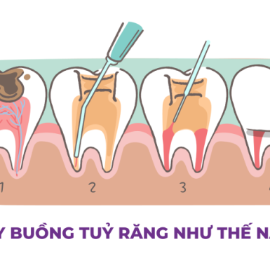 Lấy Buồng Tuỷ Răng Như Thế Nào? Tại Sao Phải Lấy Buồng tuỷ răng