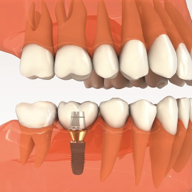 Dịch Vụ Trồng Răng Nhân Tạo Tại Nha Khoa Uy Tín Quận 1