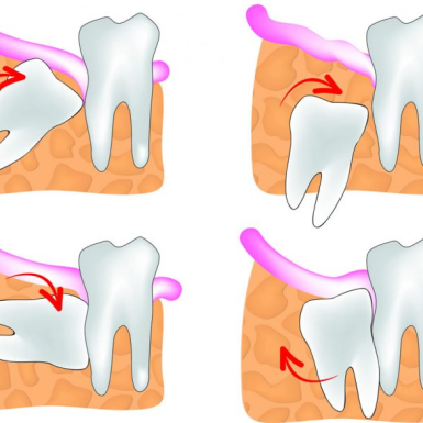 Nhổ Răng Số 8 Có Cần Không?