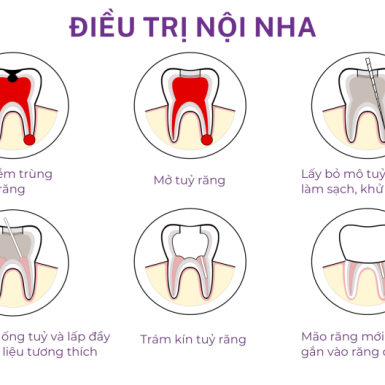 Điều Trị Nội Nha Có Đau Không?