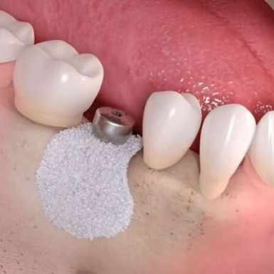 Nâng Xoang Kín Trong Cấy Ghép Implant Là Gì?