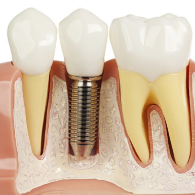 Trồng Răng Implant Có Đau Không? – Nha Khoa Ở  Quận 1