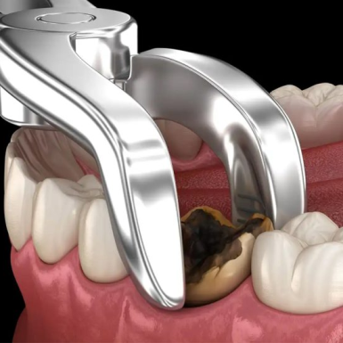 Răng số 6 là răng nào? Mất răng số 6 có ảnh hưởng gì không?