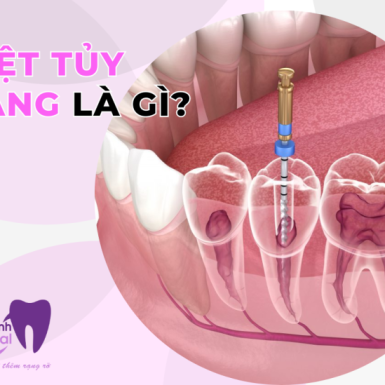 Diệt Tủy Răng Là Gì? Có Gây Ảnh Hưởng Gì Không?