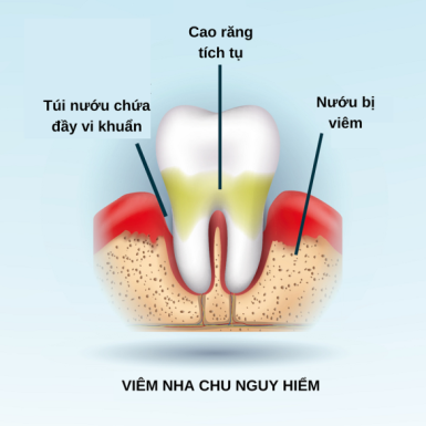 Viêm Nha Chu Nguy Hiểm Như Thế Nào?