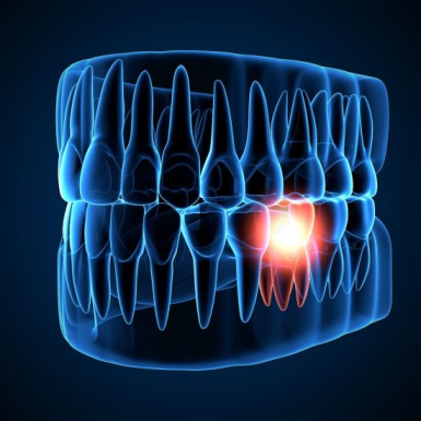 Bệnh Viêm Tủy Răng: Nguyên Nhân và Cách Điều Trị