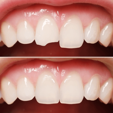 Trám Răng Thẩm Mỹ Bằng Composite Là Gì? Ưu, Nhược Điểm?