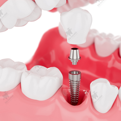 Trồng Răng Implant Giá Tốt: Bảng Giá Chi Tiết Và Cách Tối Ưu Chi Phí