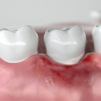 Viêm nướu: Nguyên nhân, triệu chứng, chẩn đoán và điều trị