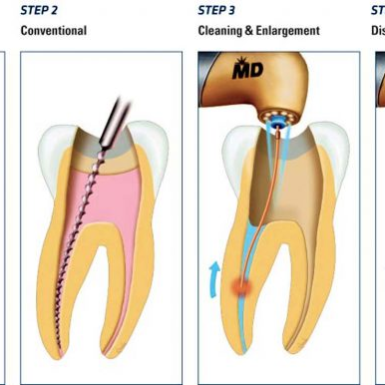 Điều Trị Tủy Răng Có Đau Không?