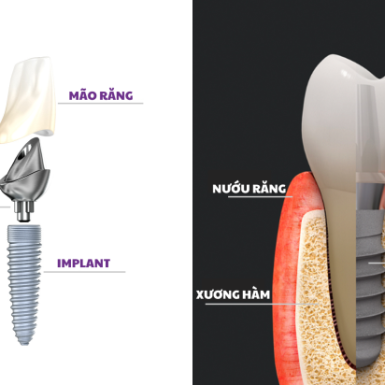 Những Lưu Ý Sau Khi Cấy Ghép Implant