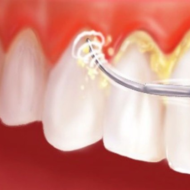 Lấy Vôi Răng Cho Bà Bầu Ở Quận 1 An Toàn