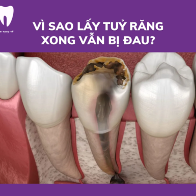 Vì Sao Lấy Tuỷ Răng Xong Vẫn Bị Đau? Cách giảm đau tại nhà