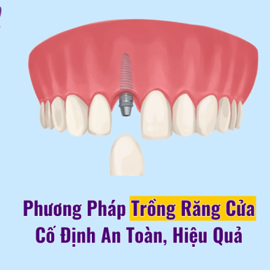 Phương Pháp Trồng Răng Cửa Cố Định An Toàn, Hiệu Quả