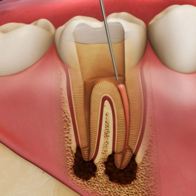 Thế Nào Là Điều Trị Nội Nha? Khi Nào Nên Điều Trị Nội Nha?
