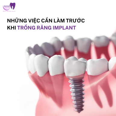 Những Việc Cần Làm Trước Khi Trồng Răng Implant
