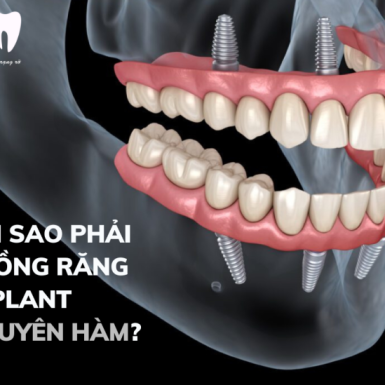 Tại Sao Phải Trồng Răng Implant Nguyên Hàm?