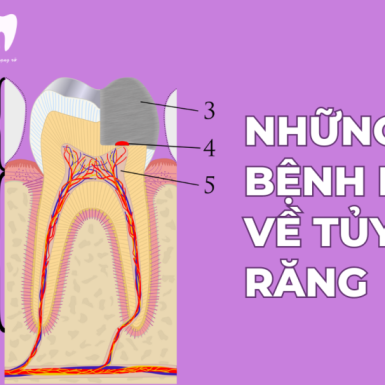 Những Bệnh Lý Về Tủy Răng Thường Gặp