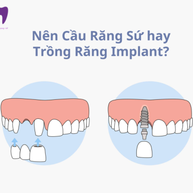 Nên Cầu Răng Sứ hay Trồng Răng Implant?