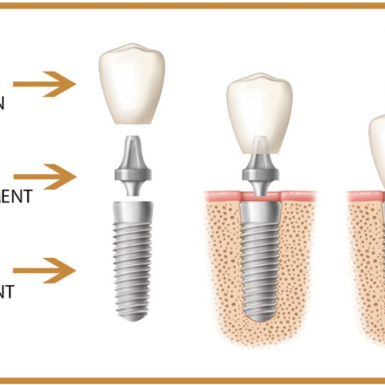 Implant Nha Khoa Tồn Tại Bao Lâu?