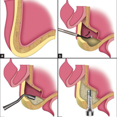Nong Xương, Ghép Xương, Nâng Xoang Trong Cấy Implant Là Gì?