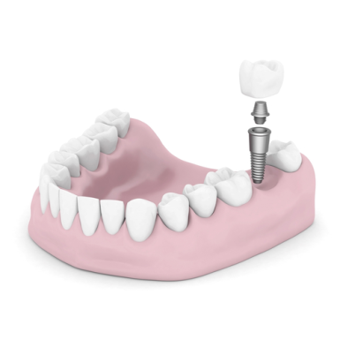 Ích Lợi Của Implant