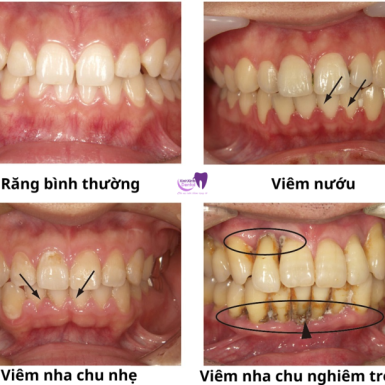 Những Dấu Hiệu của Viêm Nha Chu – Bạn không nên xem thường