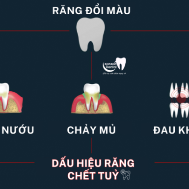 Vì sao răng chết tuỷ? Dấu Hiệu và Cách Chữa Trị
