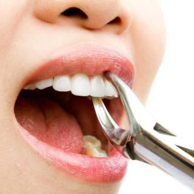 Nhổ Răng Ở Quận 1 An Toàn Và Chất Lượng