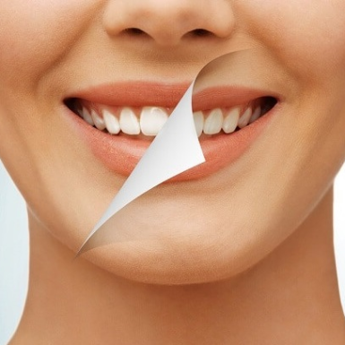 Khi nào nên tẩy trắng răng?