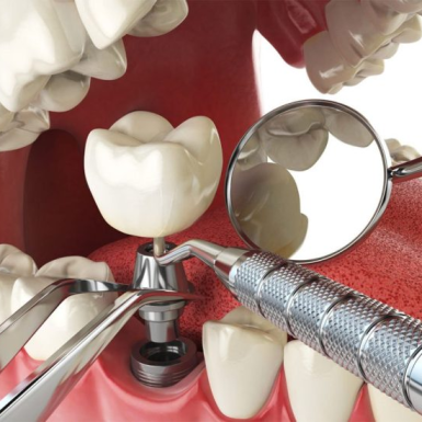 Trồng Răng Implant Có Đau Không? Cách Giảm Đau Hiệu Quả