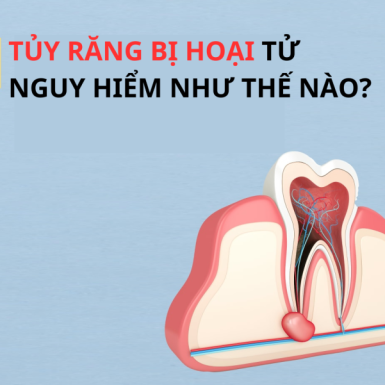 Tủy răng bị hoại tử nguy hiểm như thế nào? Cách điều trị dứt điểm