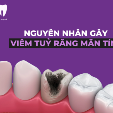 Nguyên Nhân Gây Viêm Tuỷ Răng Mãn Tính – Chữa Trị Như Thế nào