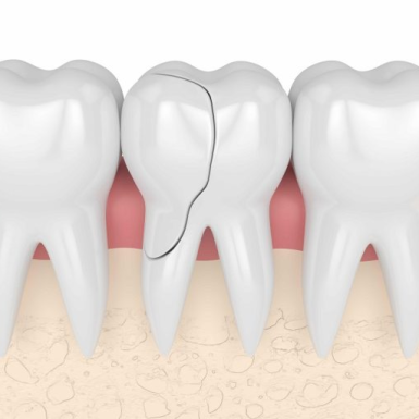 Tại Sao Răng Lấy Tuỷ bị vỡ? Cách điều trị hiệu quả