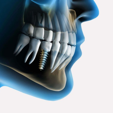 Có Bao Nhiêu Loại Implant – Nha Khoa Xinh Xinh