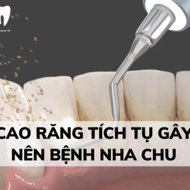 Cao Răng Tích Tụ Gây Nên Bệnh Nha Chu