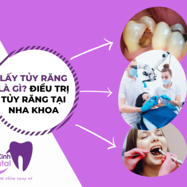 Lấy Tủy Răng Là Gì? Điều Trị Tủy Răng tại Nha Khoa