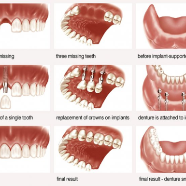 Tại Sao Nên Chọn Implant?