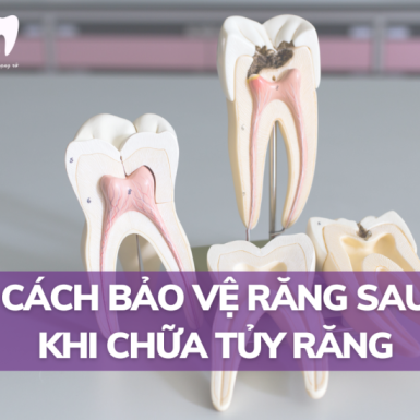 Cách Bảo Vệ Răng Sau Khi Chữa Tủy Răng