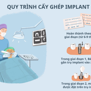 Quy Trình Cấy Ghép Implant Tại Nha Khoa