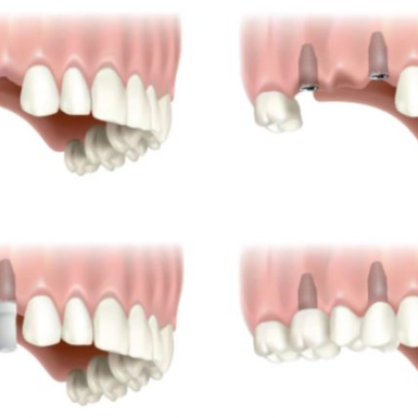 Trồng Răng Implant Ở Đâu Tốt Quận 1